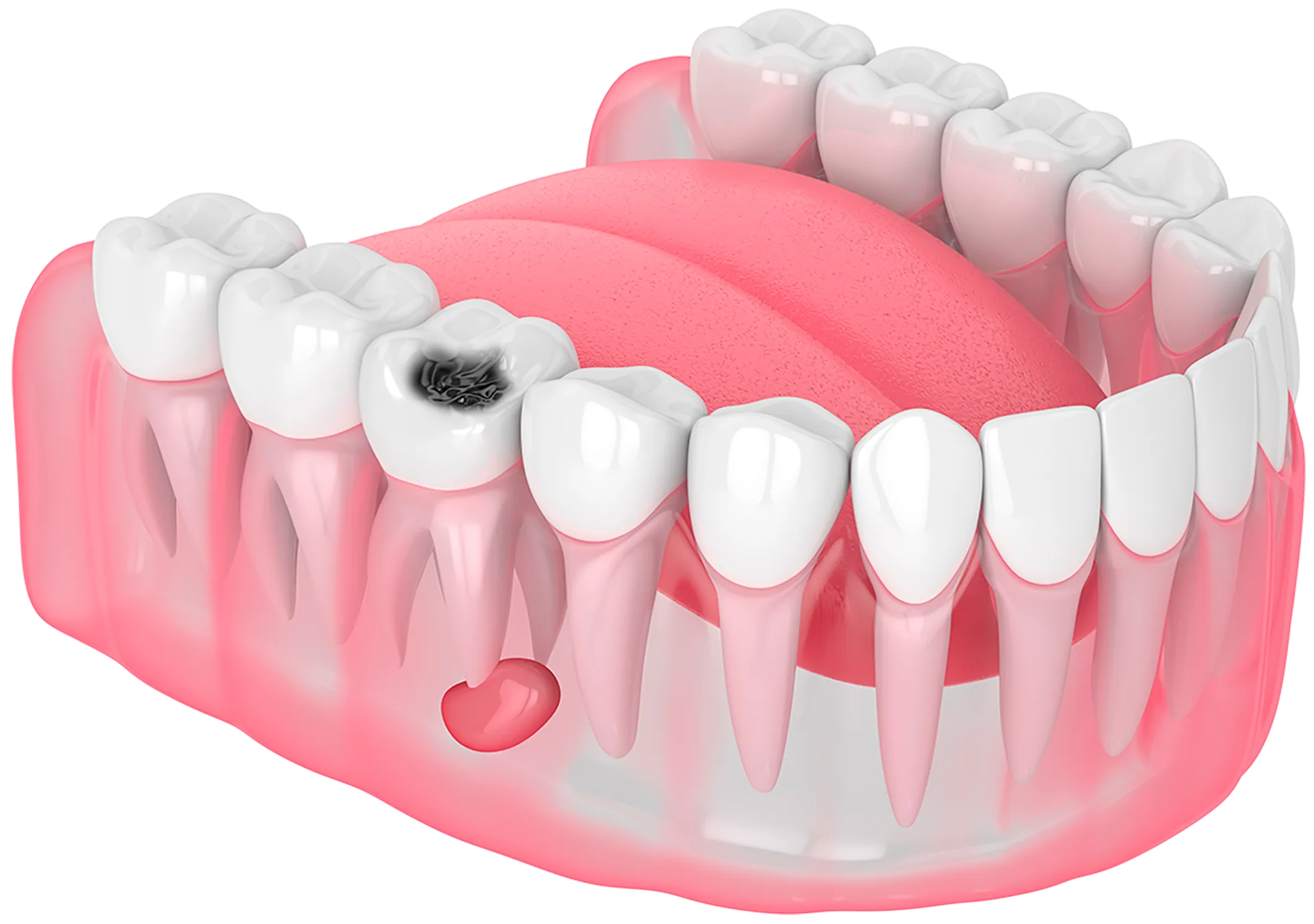 Odontopediatría caries