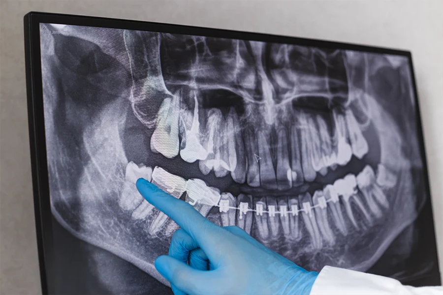 Ilustración de una extracción dental de muelas del juicio